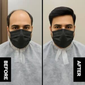 Hair Taping Result